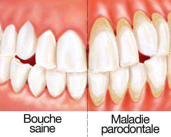 parodontite